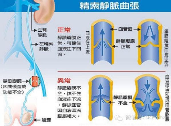 關(guān)于2021年征兵精索靜脈曲張標(biāo)準(zhǔn)的探討，2021年征兵精索靜脈曲張標(biāo)準(zhǔn)深度解析